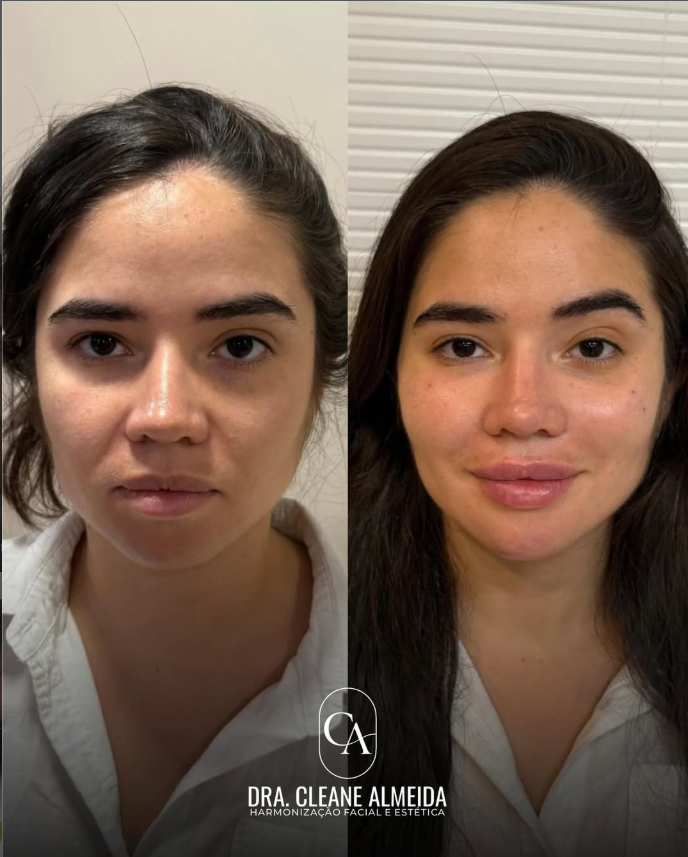 Antes e depois — harmonização completa