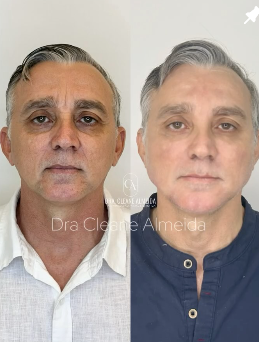 Antes e depois — harmonização masculina
