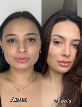 Antes e depois — rejuvenescimento facial
