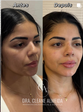 Antes e depois — contorno e perfil
