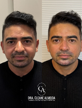 Antes e depois — definição facial masculina