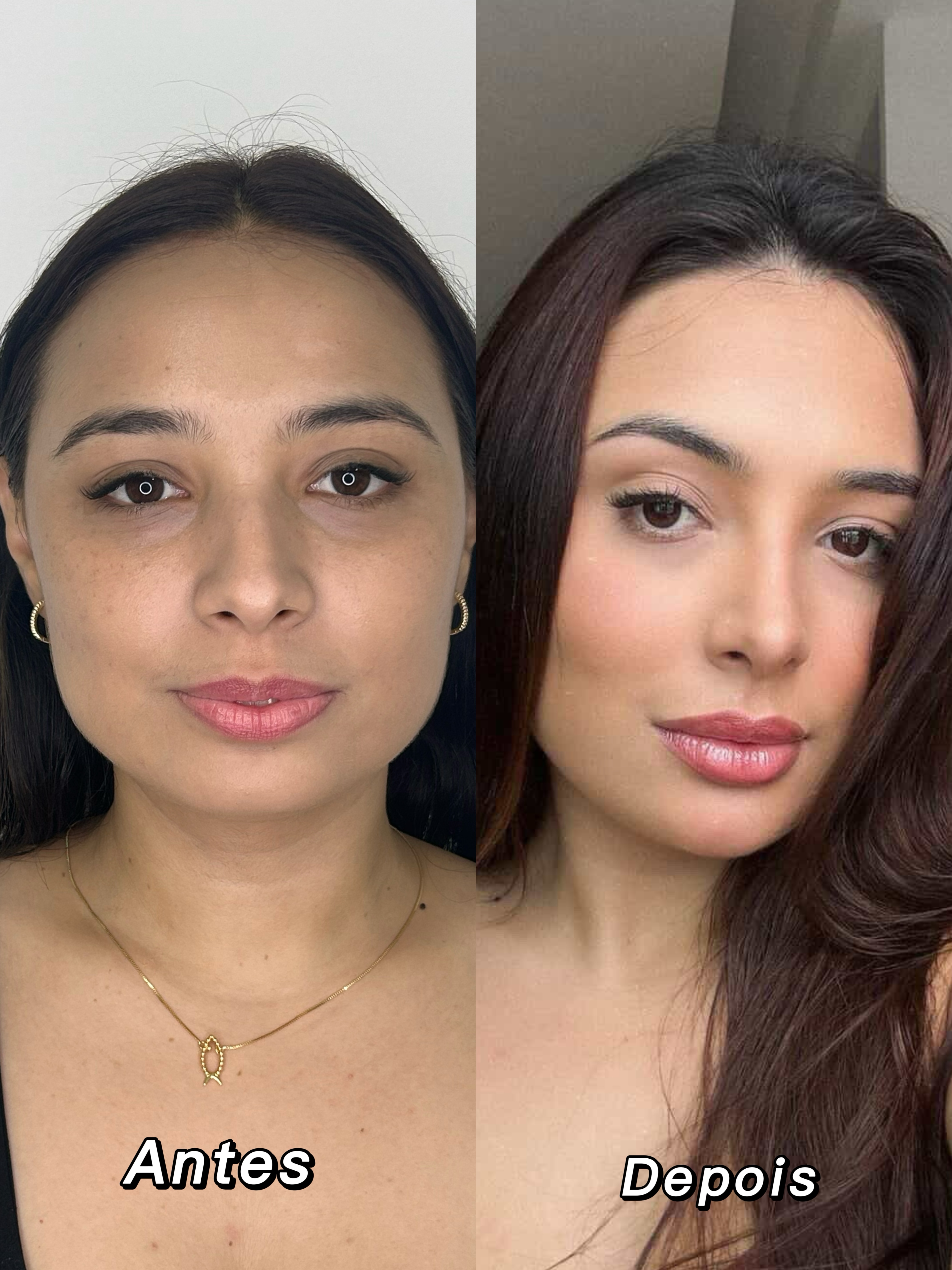 Antes e depois — lábios