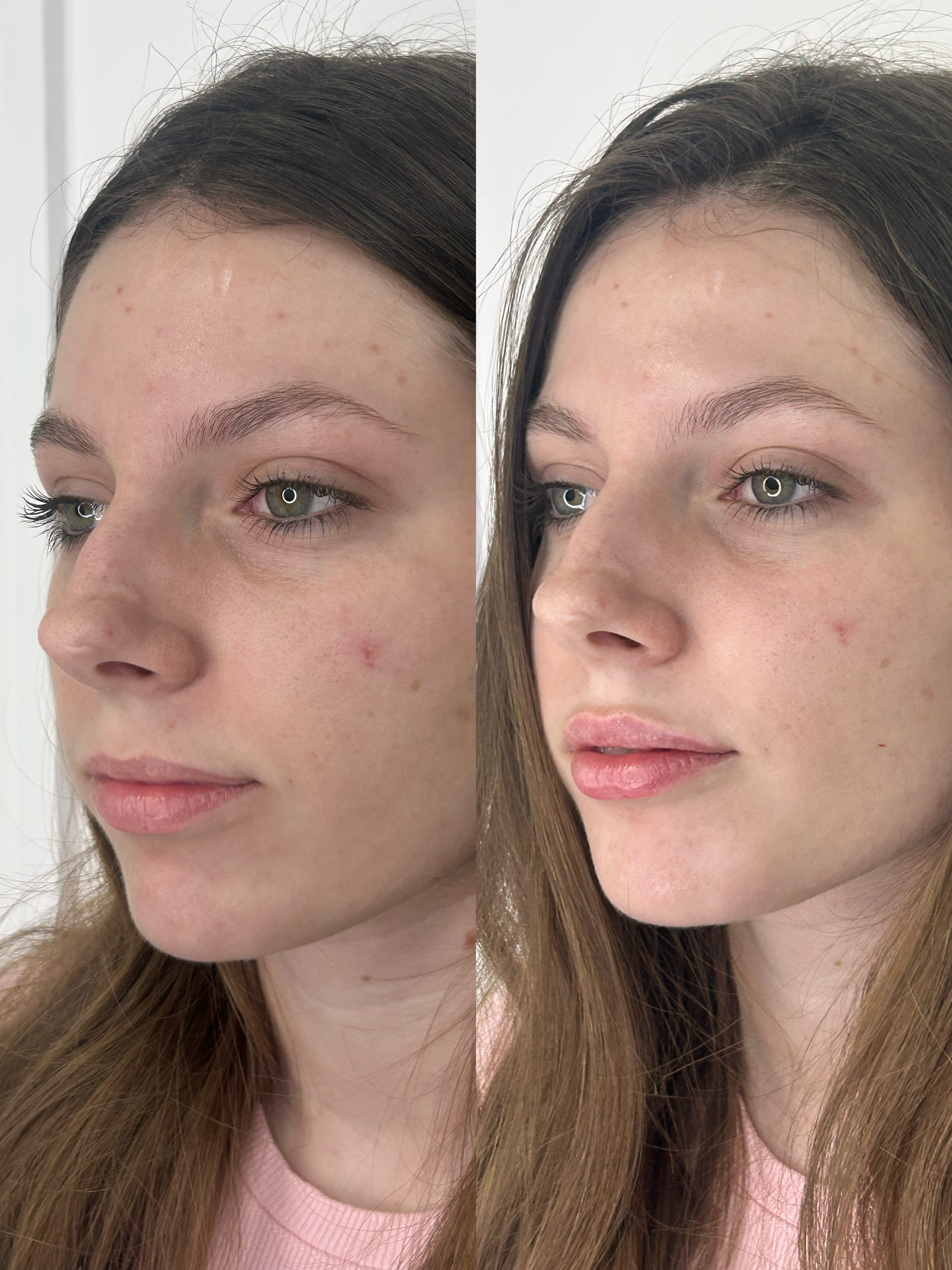 Antes e depois — lábios e viço